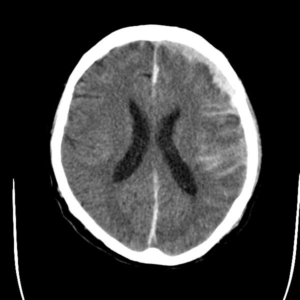 File:Cerebral hemorrhagic contusions (Radiopaedia 23145-23188 Axial non-contrast 24).jpg