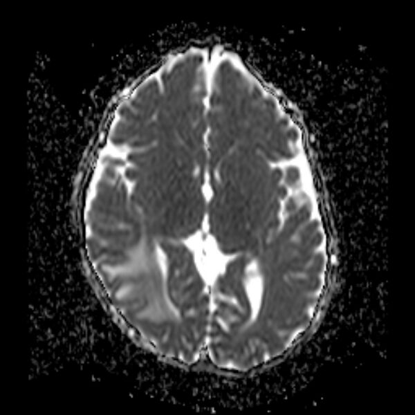 File:Cerebral tuberculoma (Radiopaedia 41152-43932 Axial ADC 11).jpg