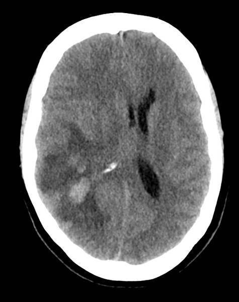 File:Cerebral venous infarct related to dural venous sinus thromboses (Radiopaedia 35292-36803 AXIAL THICK 16).png
