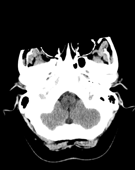 File:Cerebral venous infarct related to dural venous sinus thromboses (Radiopaedia 35292-36803 AXIAL THICK 4).png