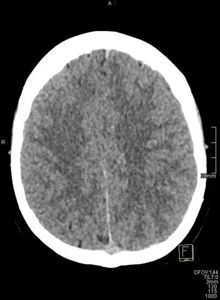 File:Cerebral venous sinus thrombosis (Radiopaedia 91329-108965 Axial non-contrast 36).jpg