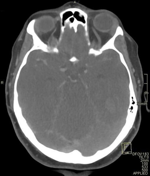 File:Cerebral venous sinus thrombosis (Radiopaedia 91329-108965 Axial venogram 32).jpg