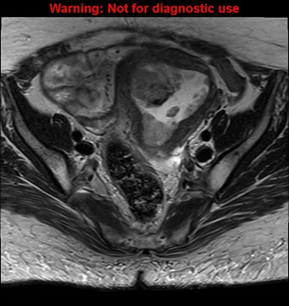 File:Cervical cancer (Radiopaedia 24151-24410 Axial T2 11).jpg
