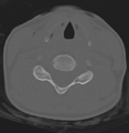 Cervical disc replacement (Radiopaedia 37383-39205 Axial bone window 4).png