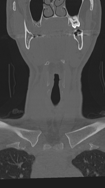 File:Cervical intercalary bone (Radiopaedia 35211-36748 Coronal bone window 5).png