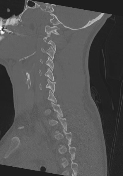 File:Cervical intercalary bone (Radiopaedia 35211-36748 Sagittal bone window 27).png