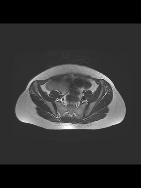 File:Cesarean section scar endometrioma (Radiopaedia 56569-63297 Axial T2 6).jpg