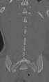 Chance fracture (Radiopaedia 40360-42912 Coronal bone window 57).png