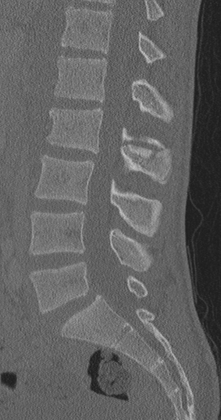 File:Chance fracture (Radiopaedia 40360-42912 Sagittal bone window 52).png