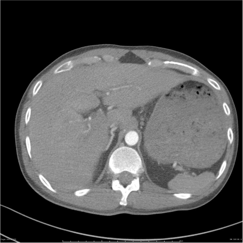 Chest and abdomen multi-trauma (Radiopaedia 26294-26425 A 100).jpg