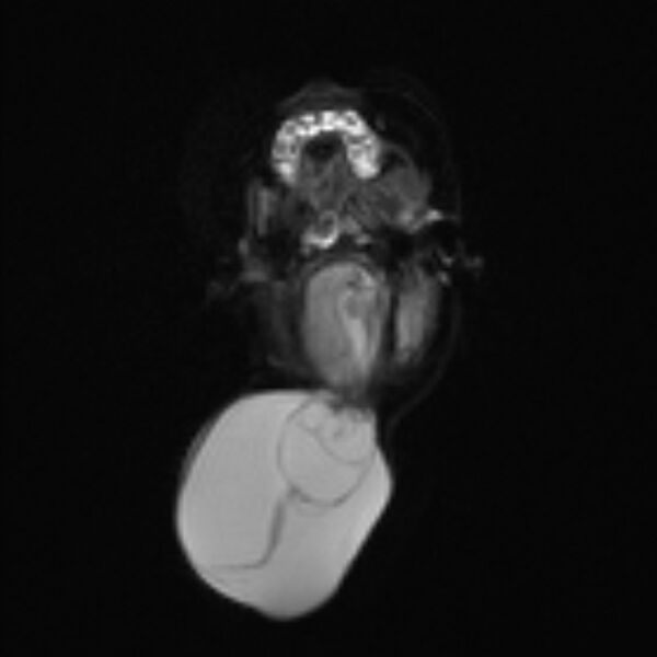 File:Chiari III malformation with occipital encephalocele (Radiopaedia 79446-92559 Axial DWI 9).jpg