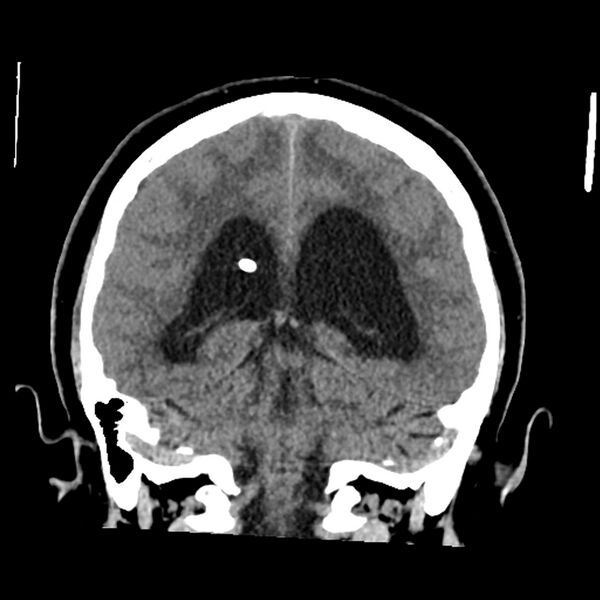 File:Chiasmatic-hypothalamic juvenile pilocytic astrocytoma (Radiopaedia 78533-91237 Coronal non-contrast 45).jpg