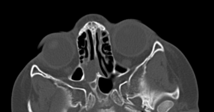 Choanal atresia (Radiopaedia 51295-56972 Axial bone window 37).jpg