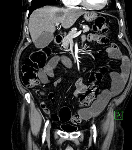 File:Cholangiocarcinoma with cerebral metastases (Radiopaedia 83519-98629 E 37).jpg
