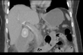 Cholecystitis - CT IVC obstructive choledocholitiasis (Radiopaedia 43966-47479 Coronal Biliscopin 25).png