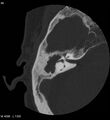 Cholesteatoma (Radiopaedia 5467-7197 Axial bone window 8).jpg