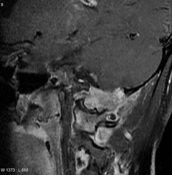 File:Chondroblastoma - occipital condyle (Radiopaedia 5569-7306 E 1).jpg