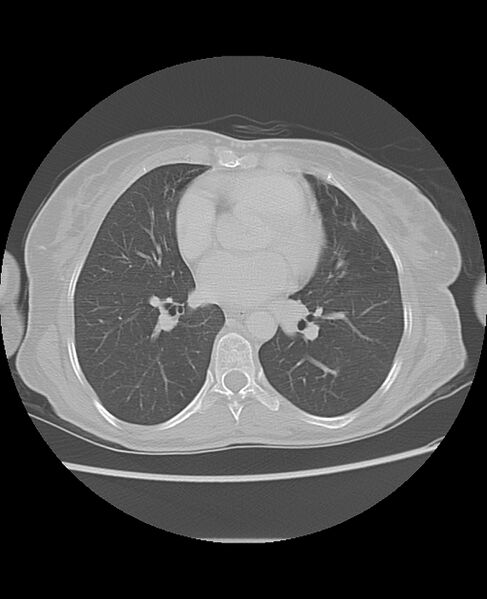 File:Chondrosarcoma (Radiopaedia 79427-92532 Axial lung window 32).jpg