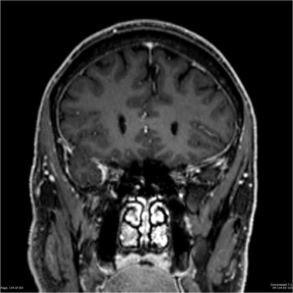 File:Chondrosarcoma of skull base- grade II (Radiopaedia 40948-43654 Coronal T1 C+ 45).jpg