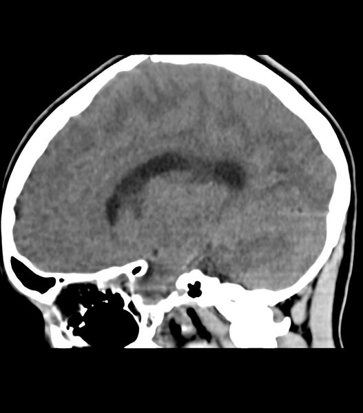 File:Choroid plexus carcinoma (Radiopaedia 91013-108552 B 30).jpg