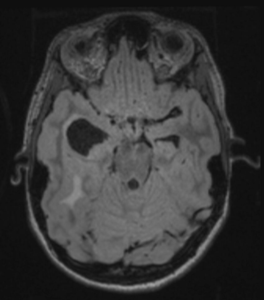 Choroid plexus carcinoma (Radiopaedia 91013-108553 Axial FLAIR C+ 110).jpg