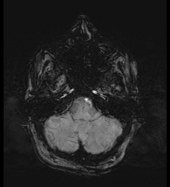 File:Choroid plexus xanthogranuloma (Radiopaedia 91271-108875 Axial SWI 14).jpg