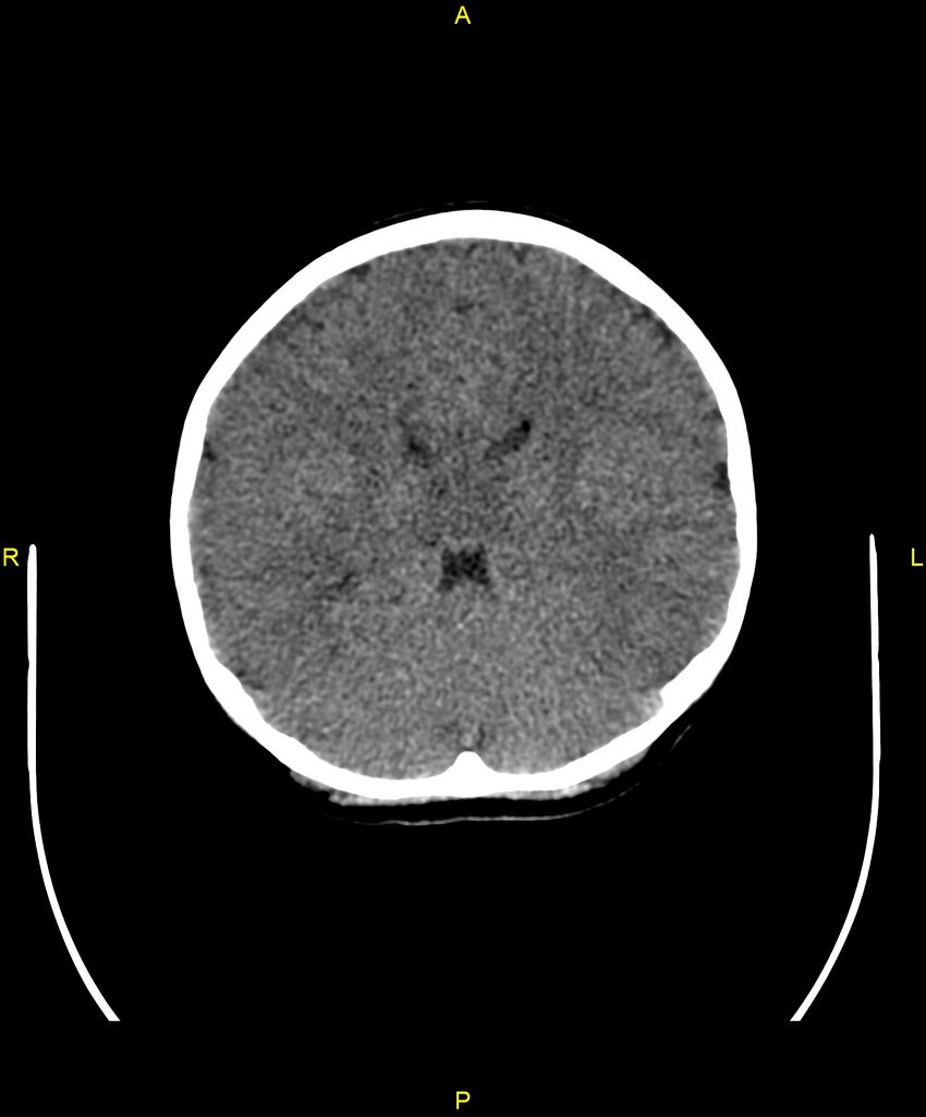 Choroidal fissure cyst (Radiopaedia 89481-106465 Axial non-contrast 72).jpg