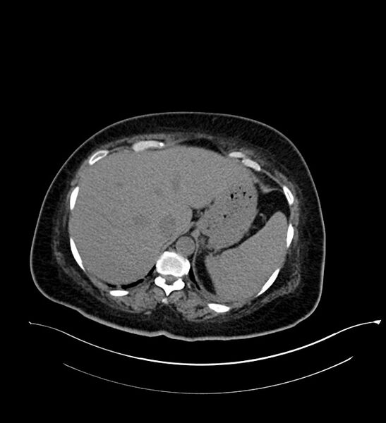 File:Chromophobe renal cell carcinoma (Radiopaedia 84239-99519 Axial non-contrast 38).jpg