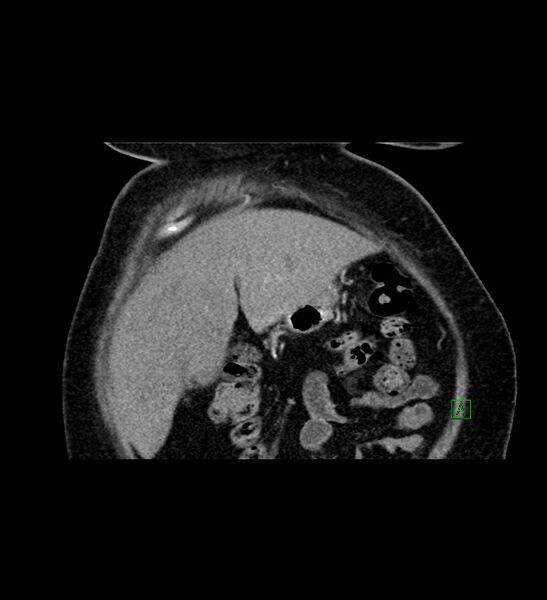 File:Chromophobe renal cell carcinoma (Radiopaedia 84239-99519 C 18).jpg