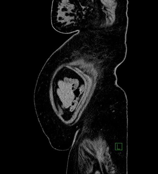 File:Chromophobe renal cell carcinoma (Radiopaedia 84239-99519 G 10).jpg