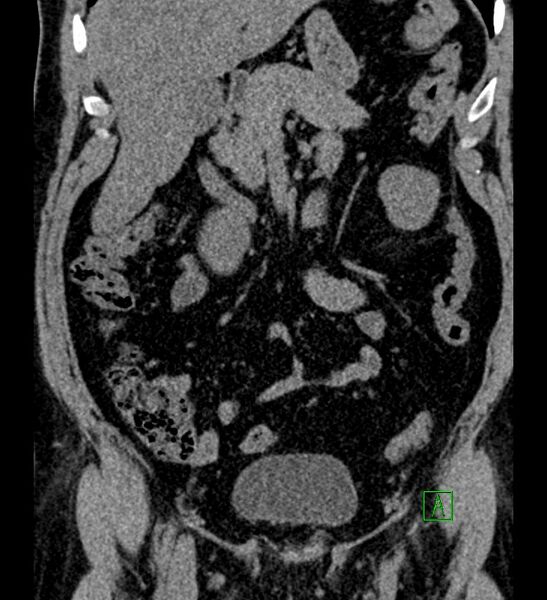 File:Chromophobe renal cell carcinoma (Radiopaedia 84286-99573 Coronal non-contrast 67).jpg