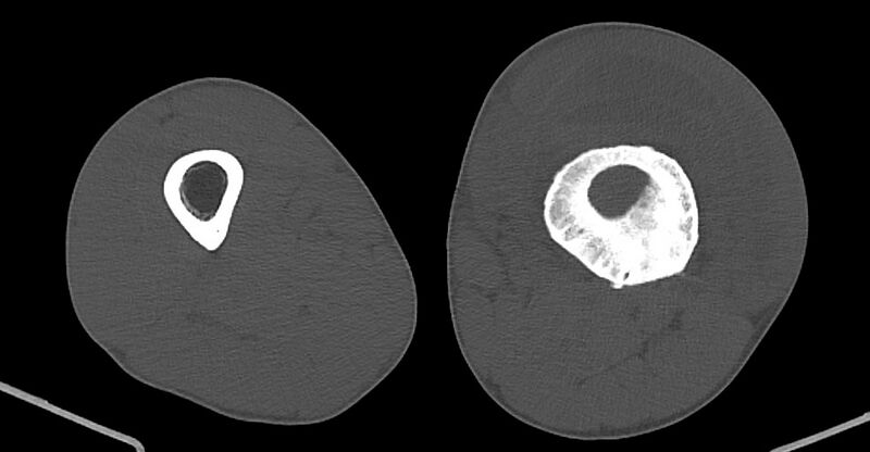 File:Chronic osteomyelitis (with sequestrum) (Radiopaedia 74813-85822 Axial non-contrast 118).jpg