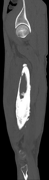 File:Chronic osteomyelitis (with sequestrum) (Radiopaedia 74813-85822 C 85).jpg