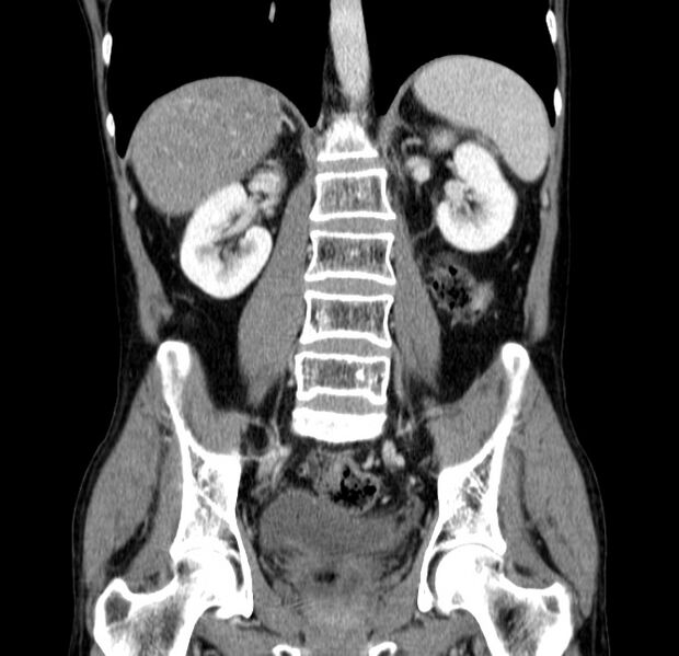 File:Chronic pancreatitis (Radiopaedia 23132-23172 C 39).jpg
