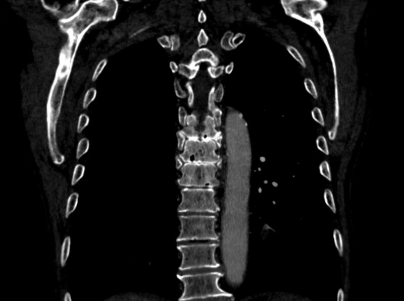 File:Chronic pulmonary embolism (Radiopaedia 91241-108843 A 87).jpg