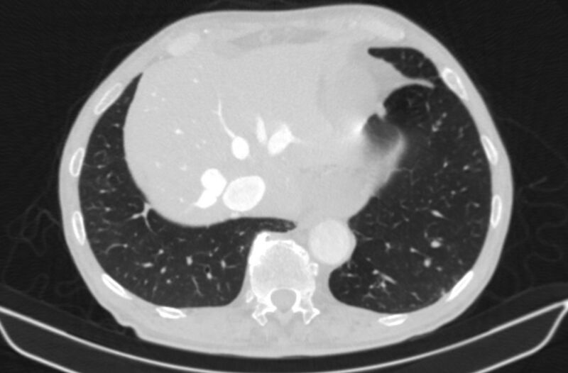 File:Chronic pulmonary embolism (Radiopaedia 91241-108843 Axial lung window 79).jpg
