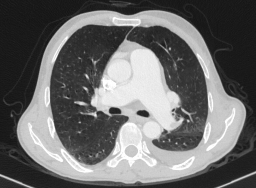 Chronic pulmonary embolism with bubbly consolidation (Radiopaedia 91248-108850 Axial lung window 74).jpg