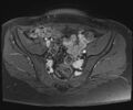 Class II Mullerian duct anomaly- unicornuate uterus with rudimentary horn and non-communicating cavity (Radiopaedia 39441-41755 Axial T1 fat sat 34).jpg