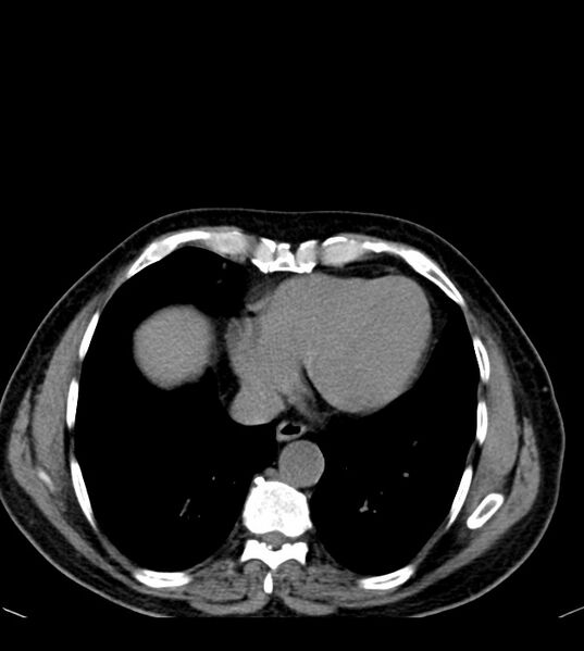 File:Clear cell renal cell carcinoma (Radiopaedia 85006-100539 Axial non-contrast 10).jpg