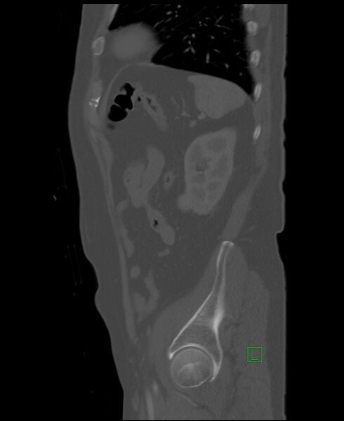 File:Clear cell renal cell carcinoma (Radiopaedia 85006-100539 Sagittal bone window 13).jpg