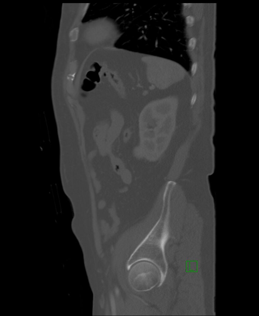 Clear cell renal cell carcinoma (Radiopaedia 85006-100539 Sagittal bone window 13).jpg
