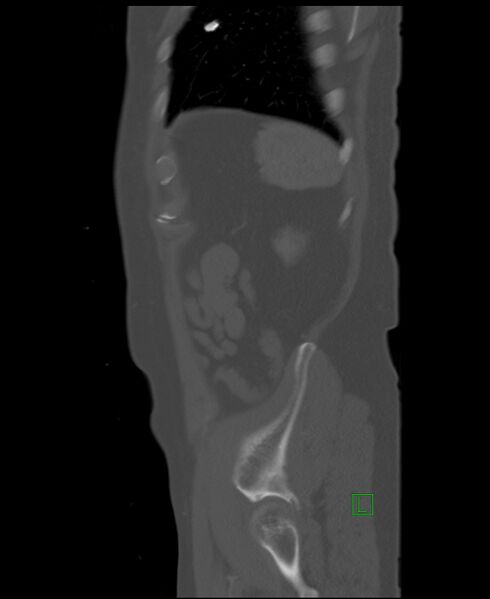File:Clear cell renal cell carcinoma (Radiopaedia 85006-100539 Sagittal bone window 9).jpg