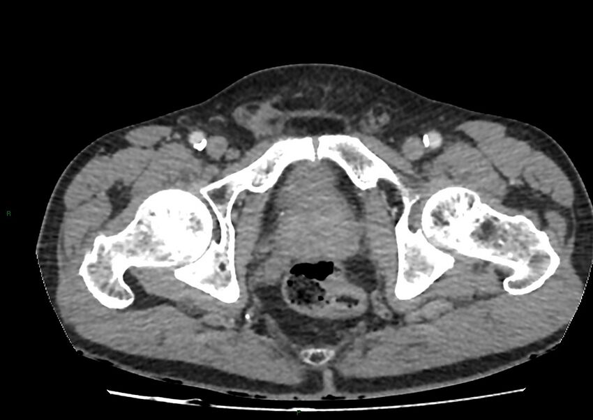 Closed loop small bowel obstruction with ischemia (Radiopaedia 84180-99456 A 118).jpg