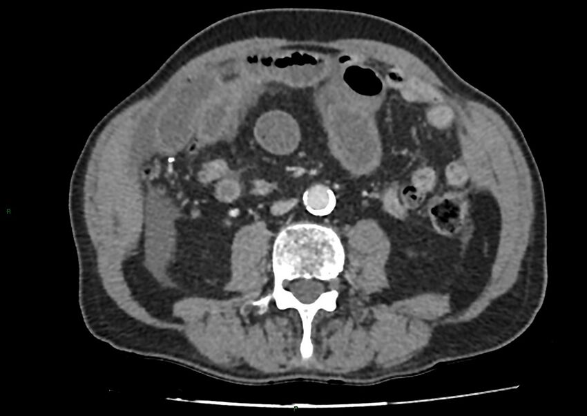 Closed loop small bowel obstruction with ischemia (Radiopaedia 84180-99456 A 62).jpg