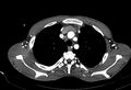 Coarctation of aorta with aortic valve stenosis (Radiopaedia 70463-80574 A 22).jpg