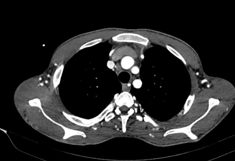 File:Coarctation of aorta with aortic valve stenosis (Radiopaedia 70463-80574 A 22).jpg