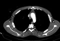 Coarctation of aorta with aortic valve stenosis (Radiopaedia 70463-80574 A 37).jpg