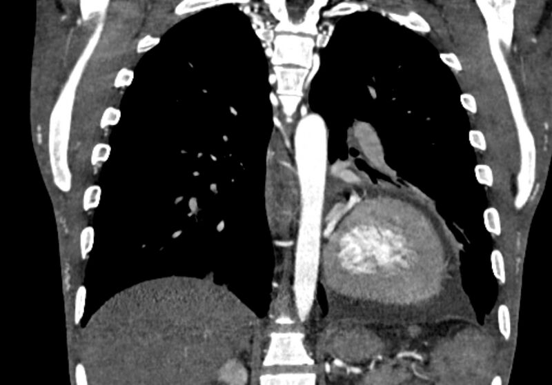 File:Coarctation of aorta with aortic valve stenosis (Radiopaedia 70463-80574 C 163).jpg