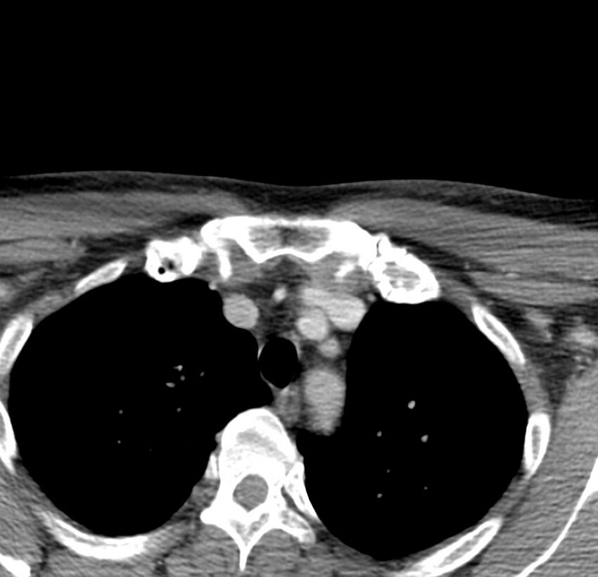 Colloid cyst of thyroid (Radiopaedia 22897-22923 Axial C+ delayed 83).jpg