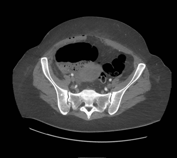 File:Colonic pseudo-obstruction (Radiopaedia 79752-92980 A 145).png